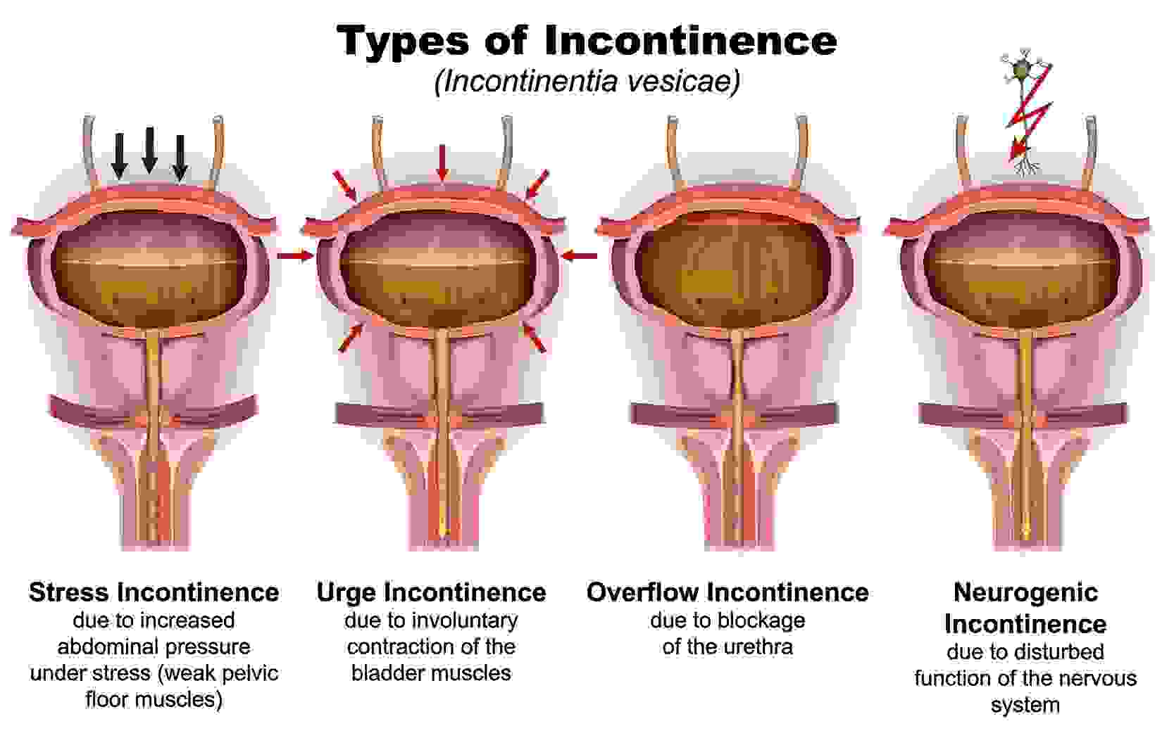 types of incontinence web jpeg.jpg