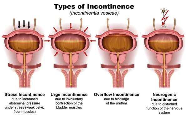types of incontinence web jpeg.jpg